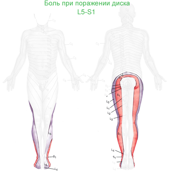 Боль в области ног при протрузии дисков l5 – s1