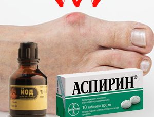 Лечение подагры на ногах аспирином и йодом