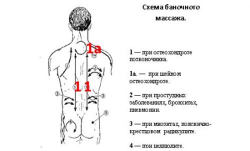 Методика баночного массажа при остеохондрозе