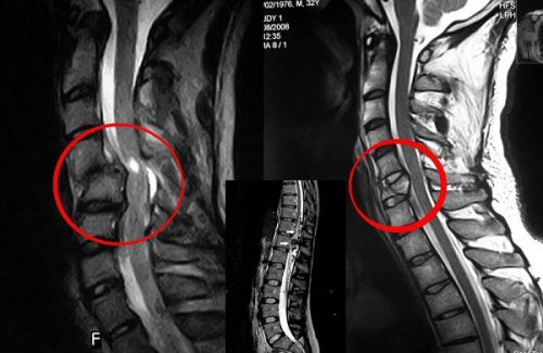 Шейный остеохондроз на МРТ снимке