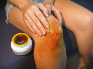 Народное лечение боли в коленном суставе