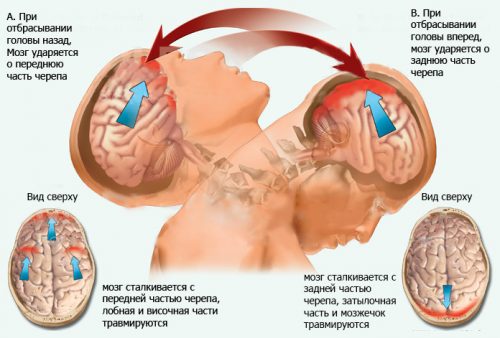 Ушиб мозга при хлыстовой травме шеи
