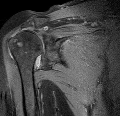 Остеоартрит плечевого сустава на МРТ