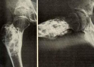 Остеобластома на рентген снимке