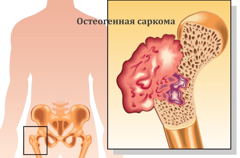 Остеогенная саркома