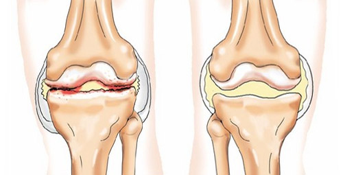 Как вылечить остеохондроз коленного сустава