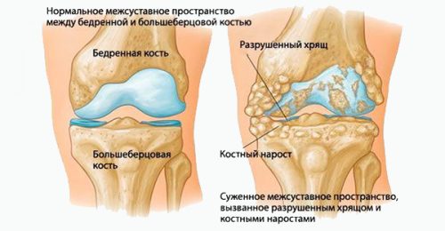 Дистрофические нарушение в коленном суставе при остеохондрозе