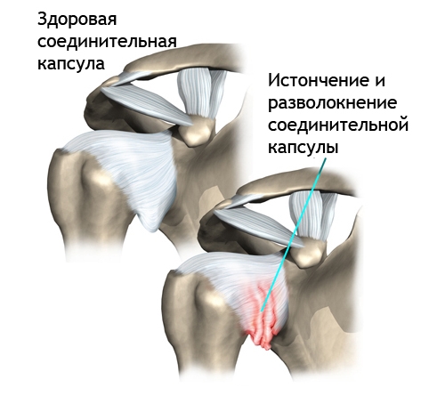 Остеохондроз плечевого сустава