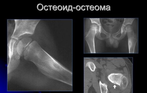 Остеоид-остеома бедренной кости