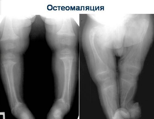 Остеомаляция на рентген снимке