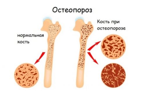 Разрушение клеток костей при остеопорозе