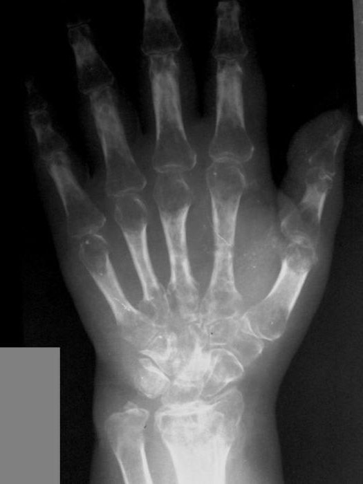 Остеопороз кисти на рентген снимке