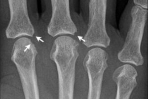 Остеопороз позвоночника на рентгене