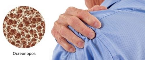 Проблема остеопороза плечевого сустава