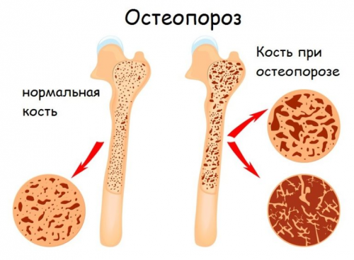 Схема остеопороза