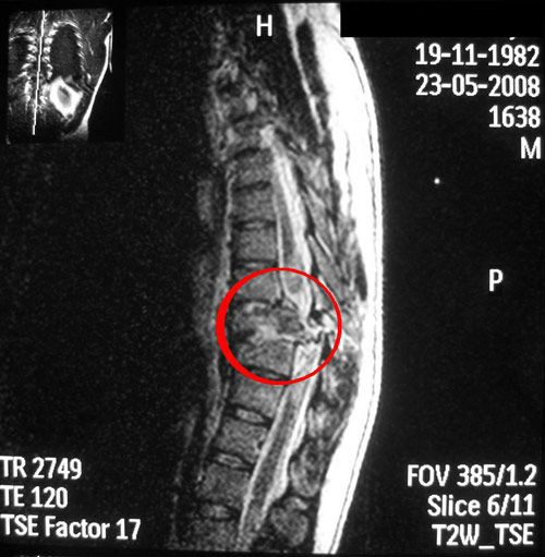 Остохондроз на МРТ снимке