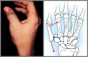 Отек и деформация при переломе пальца