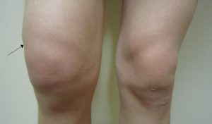 Отёк колена при гемартрозе