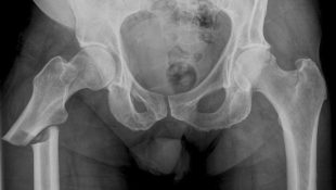 Перелом бедренной кости на рентген снимке