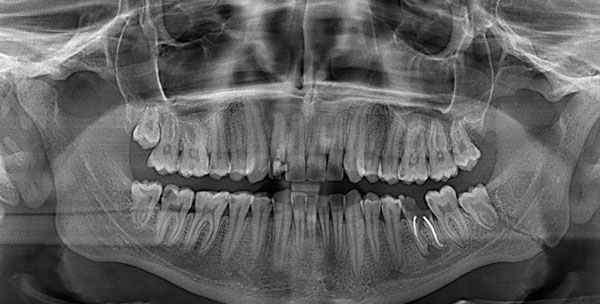 Перелом челюсти на рентген снимке
