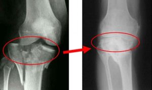 Рентген снимок перелома коленного сустава