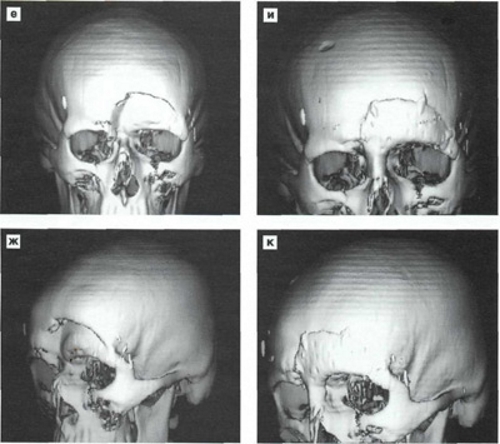 МРТ снимок перелома лобной кости