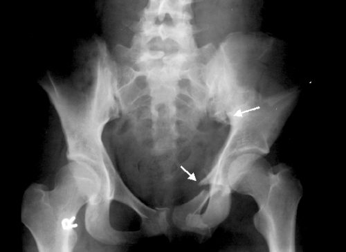 Рентгеновский снимок перелома лонной кости