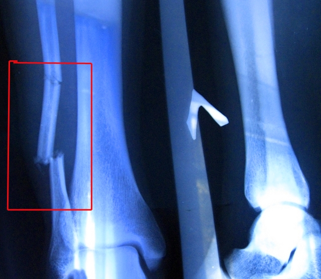 Перелом малой берцовой кости голени на рентгене