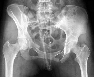 Перелом седалищной кости на рентгене