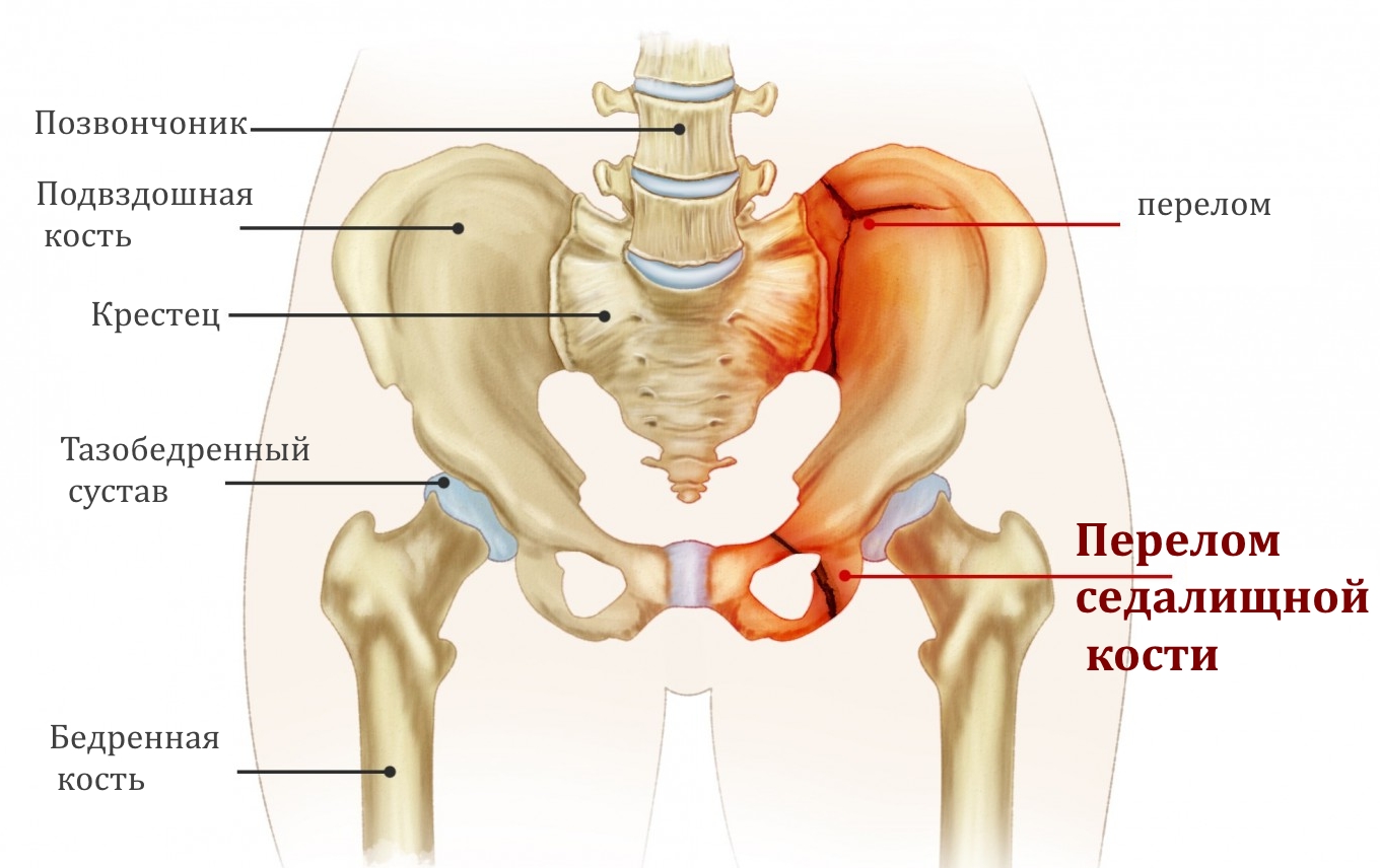 Схема перелома седалищной кости