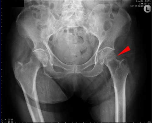 Перелом шейки бедра на рентген снимке