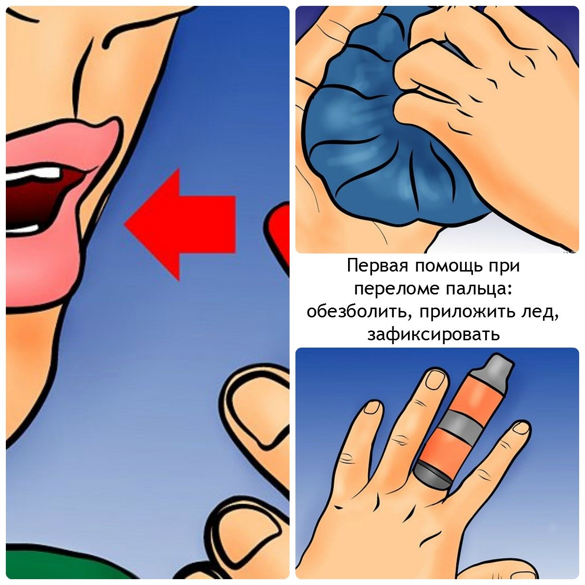 Первая помощь при переломе пальца