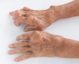 Подагрический артрит суставов рук