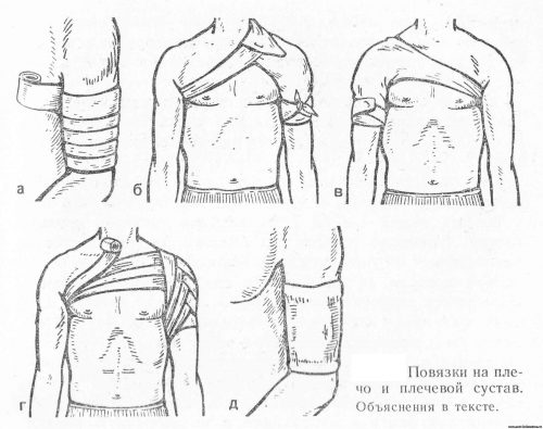 Повязки на плечо и плечевой сустав