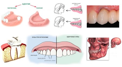Причины артроза челюсти