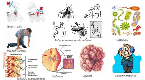 Причины плексита плеча