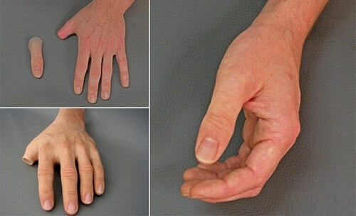 Протезирование большого пальца руки