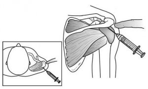 Пункция кисты плечевого сустава