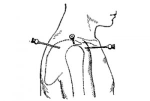 Пункция плеча с разных сторон
