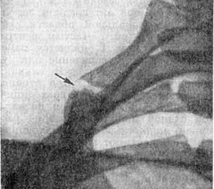 Разрушение хрящевой ткани на рентген снимке