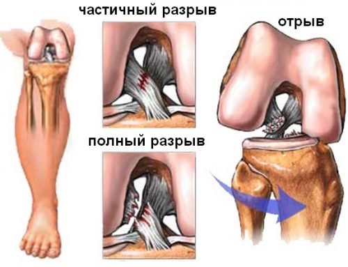 Разрыв крестообразной связки коленного сустава