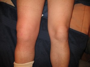 Опухание колена при разрыве связки