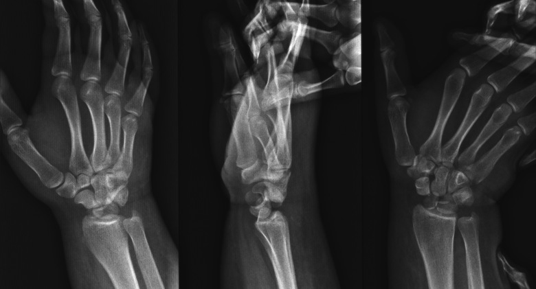 Рентген диагностика перелома ладьевидной кости