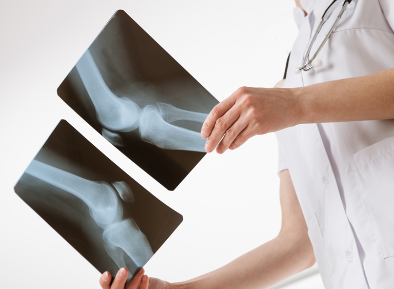 Рентген диагностика коленных суставов