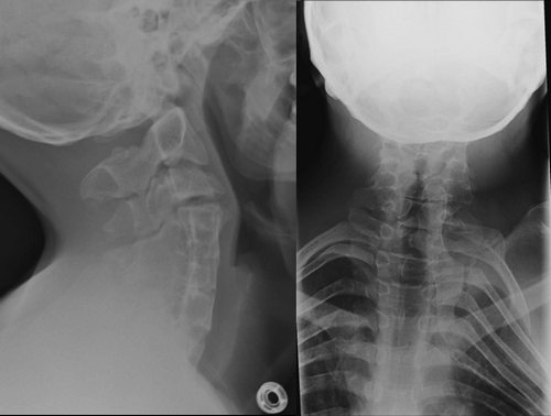 Короткая шея на рентген снимке