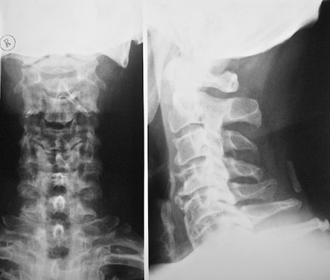 Рентген при хлыстовой травме шеи