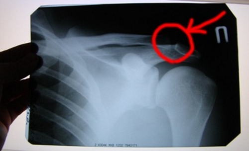 Рентген разрыва связки плеча