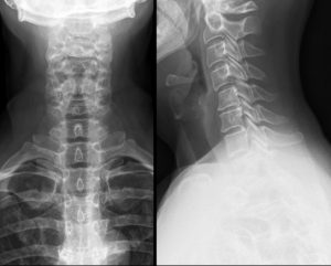 Рентген шеи в двух проекциях