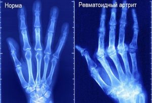 Ревматоидный артрит кисти на рентген снимке