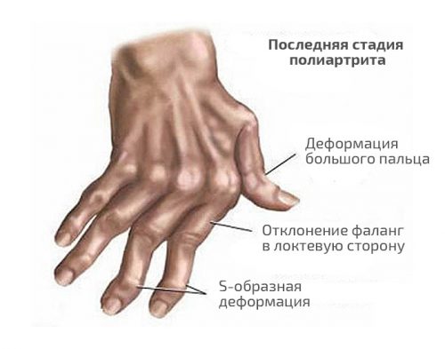 Деформации при последней стадии ревматоидного полиартрита пальцев рук
